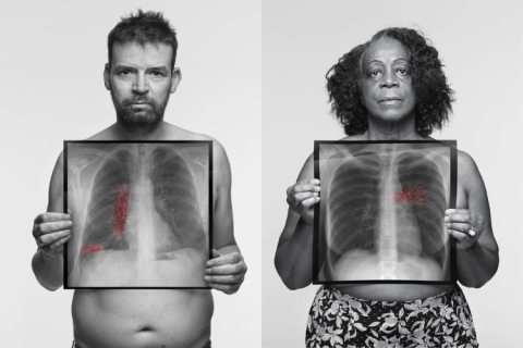 Photos taken by Rankin of a man and a woman who are never-smokers, holding chest x-rays showing their lung cancer growths